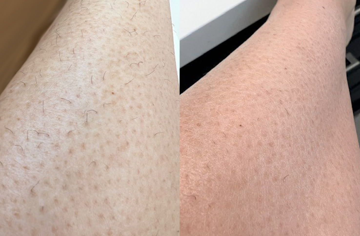 Before and after our Mini Lite
