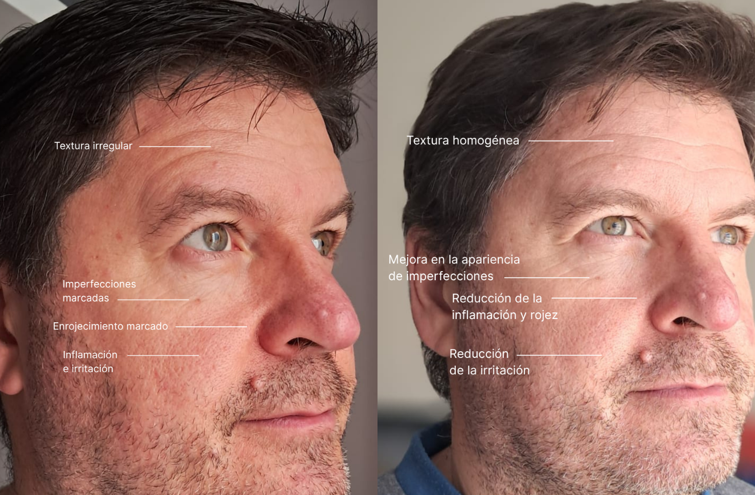 Antes y después de la Silicone LED Mask