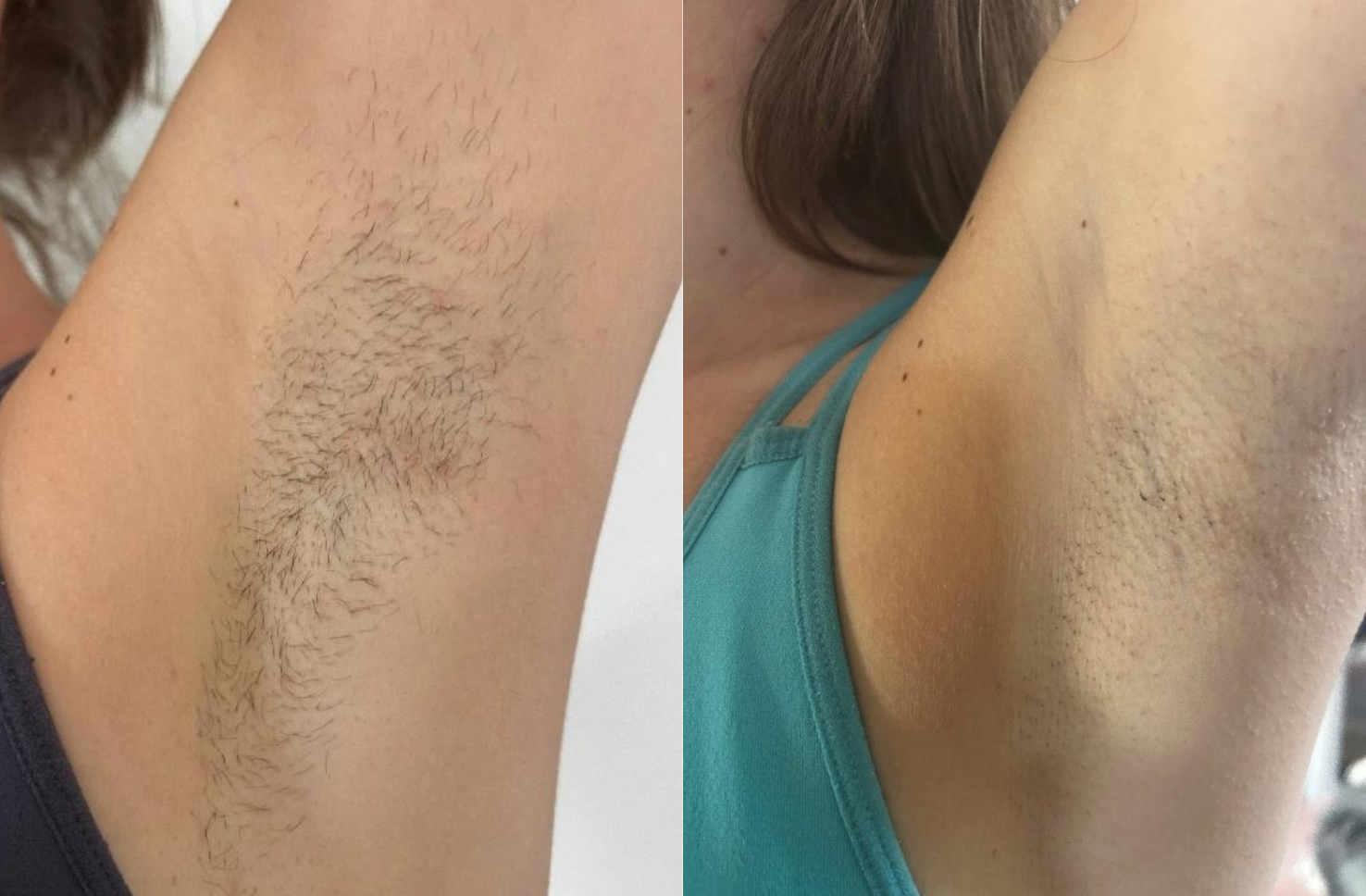 Antes y después de nuestro Pure Ice