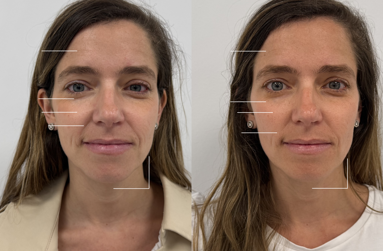 Antes y después de nuestra Silicone LED Mask