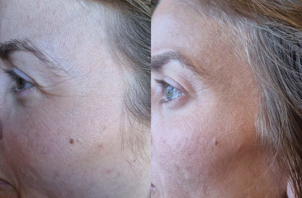 Prima e dopo il nostro TriPollar Envig Edge